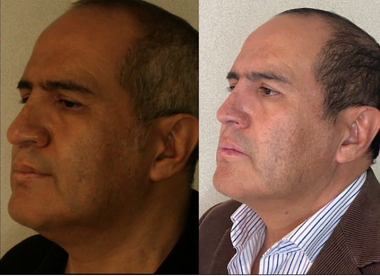 Lipopapada antes y despues