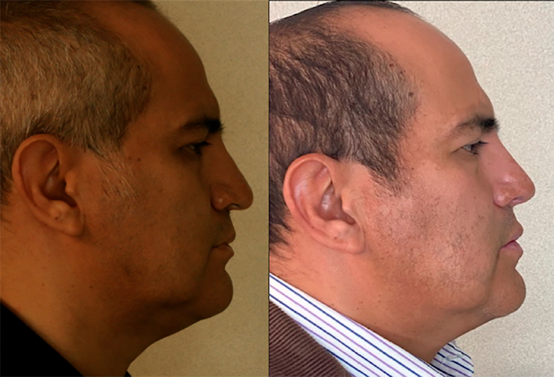 RINO + LIPO 4 MESES