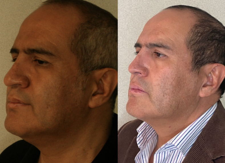 rino + lipopapada 4 meses