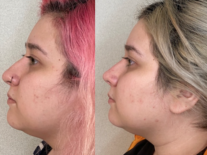 rinoplastia_un mes post